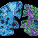 Image of Alzheimerpgingivalis brain image, credit: Jessica Wilson/Science Photo Library